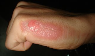 Burn Injury